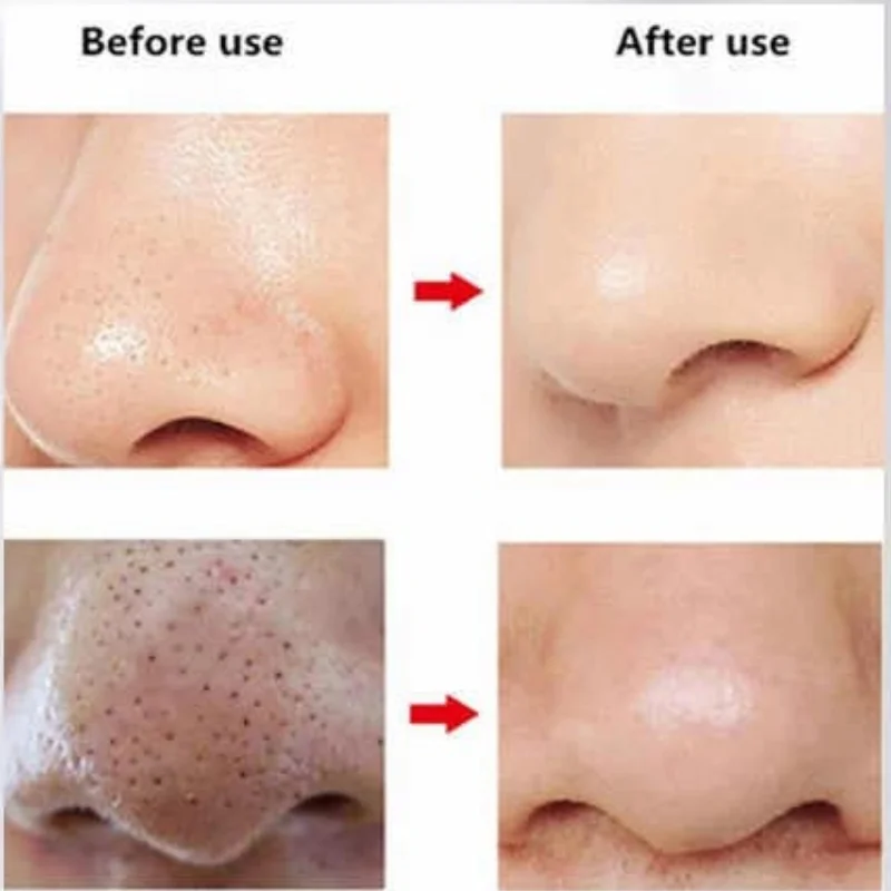 Rechargeable Blackhead Remover Vacuum Cleaner | Model FPLS-001 | Deep Pore Cleansing & Microdermabrasion Device - Image 8